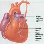 CABG